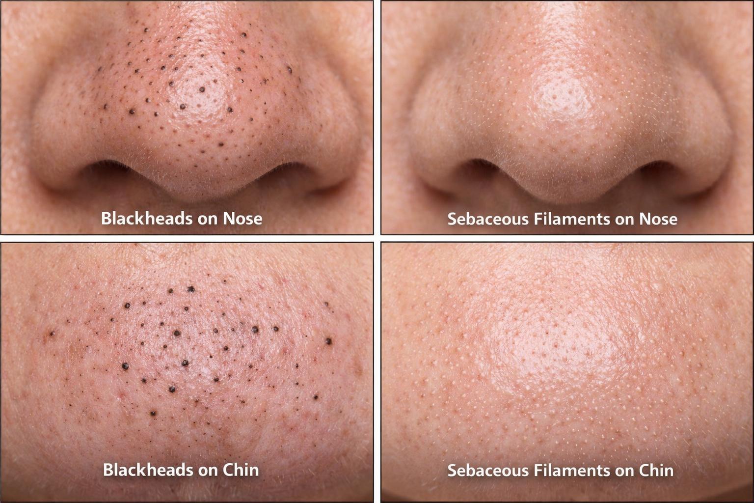 Blackheads vs. 
Sebaceous Filaments: 
Let’s Clear This Up